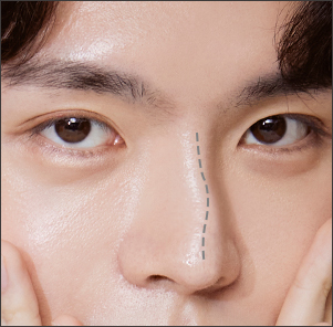 Desain 1:1 Personalized Rhinoplasty untuk Hidung Bengkok