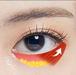 Lower Blepharoplasty - gambar detail