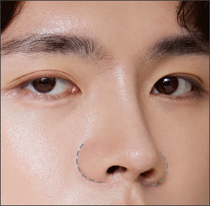 Desain 1:1 Personalized Rhinoplasty untuk Hidung Bulat