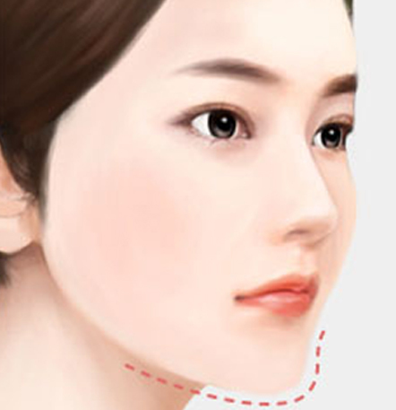 NANA Plastic Surgery<br/><b>Kapan Operasi Revisi Kontur Wajah Diperlukan?</b> - gambar detail