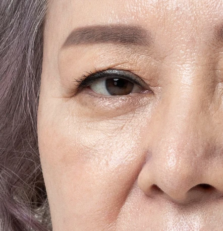 NANA Plastic Surgery <b>Siapa yang Cocok untuk Midface Lift?</b> - gambar detail