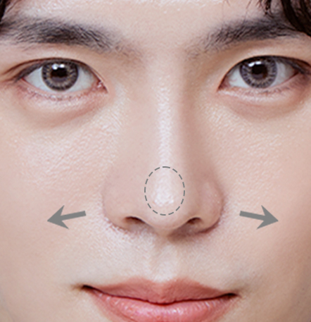 Male Rhinoplasty di NANA Plastic Surgery <br/><b>Direkomendasikan untuk yang menginginkan hasil seperti ini!</b> - gambar detail