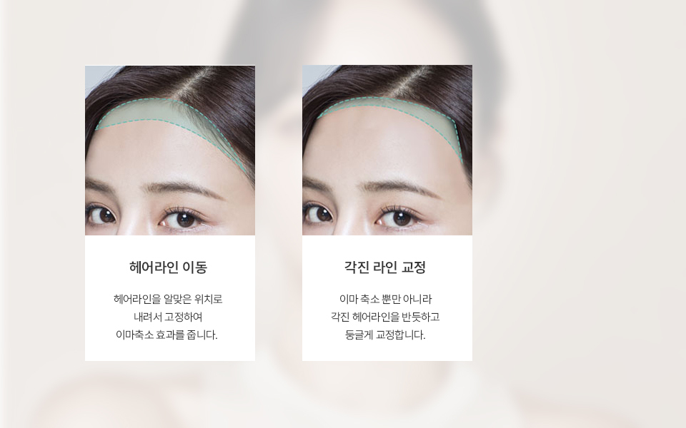 Gambar penjelasan proses Forehead Reduction NANA Plastic Surgery, contoh gambar yang menunjukkan perbaikan alami pada garis samping dahi melalui penurunan hairline dan koreksi garis dahi yang bersudut