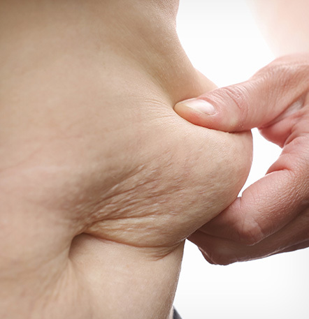 NANA Plastic Surgery <b>Tummy Tuck</b> <b>Direkomendasikan untuk Siapa?</b> - gambar detail