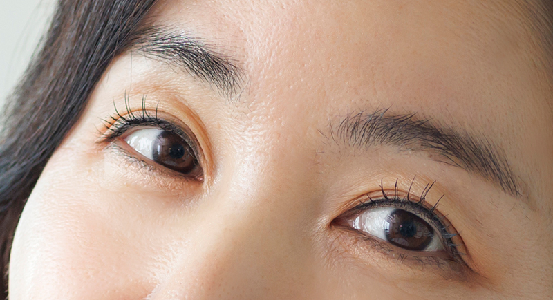 Generasi ke-5 <b>NANA Aegyo Lower Blepharoplasty</b> - gambar detail