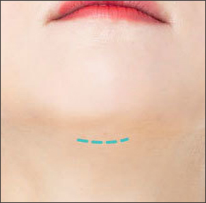 Neck Lift Keseluruhan 02 - gambar detail