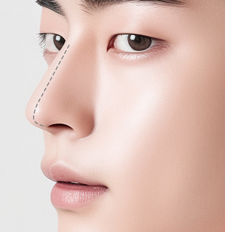Male Rhinoplasty di NANA Plastic Surgery <br/><b>Direkomendasikan untuk yang menginginkan hasil seperti ini!</b> - gambar detail