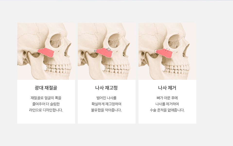 Penjelasan mengenai Operasi Revisi Tulang Pipi di NANA Plastic Surgery, termasuk metode operasi revisi yang disesuaikan dengan struktur wajah masing-masing individu.