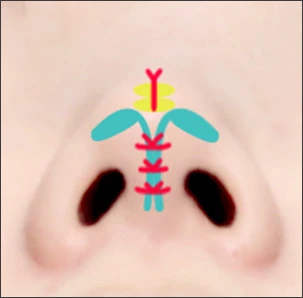 Jika tulang rawan ujung hidung melebar - gambar detail