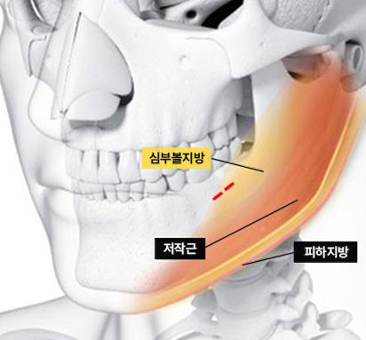 Buccal Fat Removal - gambar detail