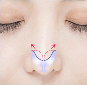 Jika tulang rawan ujung hidung berukuran besar - gambar detail