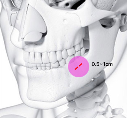 Sayatan di Dalam Mulut - gambar detail