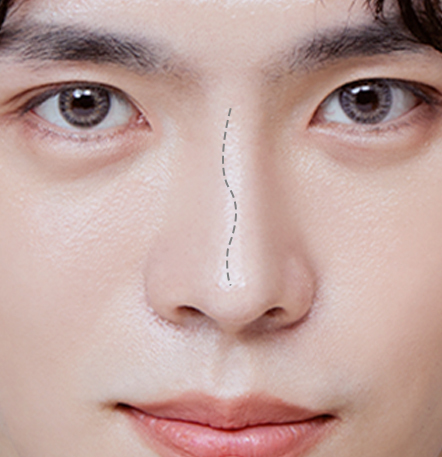 Male Rhinoplasty di NANA Plastic Surgery <br/><b>Direkomendasikan untuk yang menginginkan hasil seperti ini!</b> - gambar detail