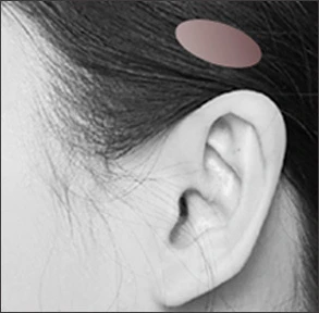 Fasia Temporalis - gambar detail