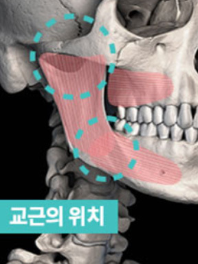 Gambar operasi pengecilan tulang pipi dengan fiksasi otot masseter pada posisi yang tepat untuk mencegah terjadinya efek samping