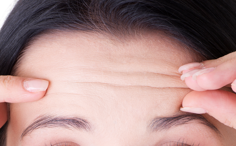 NANA Plastic Surgery<br/><b>Siapa yang Cocok untuk Forehead Lift?</b> - gambar prosedur