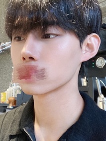 Ulasan Rhinoplasty oleh identii