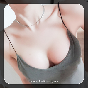 황선경's Breast Augmentation, Mentor, Smooth review