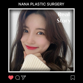 절개눈매교정 재수술, 앞트임, 코, 윤곽3종, 풀페이스지방이식 후기