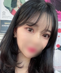 절개쌍꺼풀(재수술) 후기