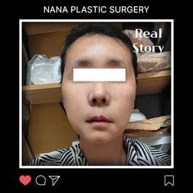 안면거상 후기