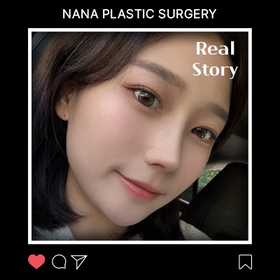 콧대 코끝 절골 매부리 긴코 복코 후기
