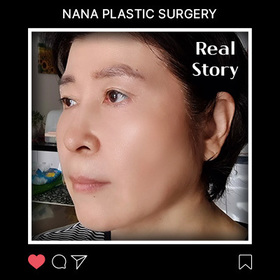 민트실리프팅, 상안검, 하안검, 지방제거 후기