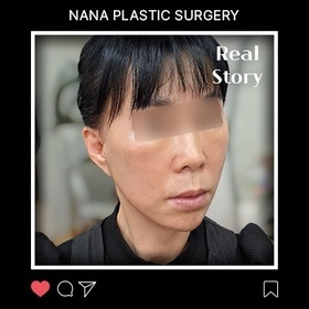 안면거상 후기