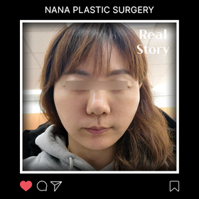 안면거상 후기