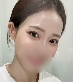 매몰쌍꺼풀 (재수술) 후기