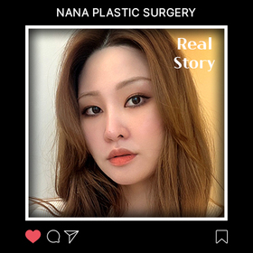 앞트임, 윗트임 후기