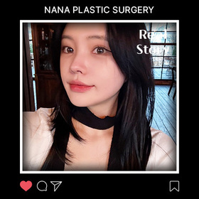 윤곽, 지방이식 후기