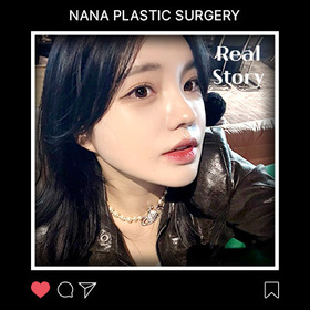 윤곽, 지방이식 후기
