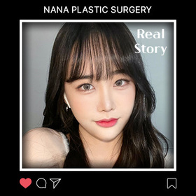 광대, 매몰, 앞트임, 밑트임, 지방이식 후기