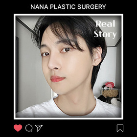 윤곽3종, 절개눈매교정, 코 후기