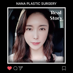 광대, 앞턱, 풀페이스지방이식 후기