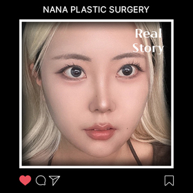 콧대 코끝 매부리 짧은코 후기
