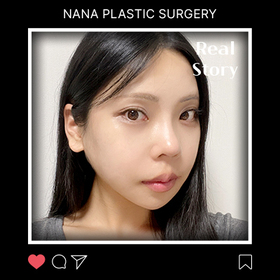 안면윤곽 후기