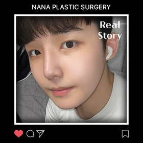 윤곽3종, 비절개 눈매교정 후기