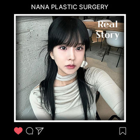 윤곽 3종,절개눈매교정,재수술 후기
