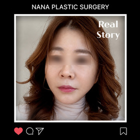 안면거상 후기