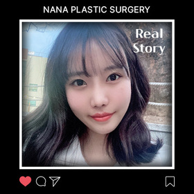 광대, 가슴, 매몰재, 앞트임, 듀얼트임, 코 후기