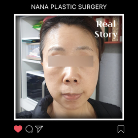 안면거상 후기