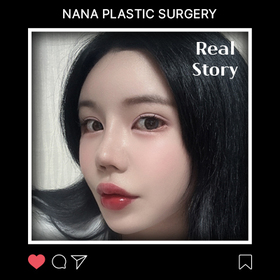 절개눈매교정 후기