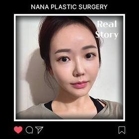 광대,사각턱,앞턱 후기