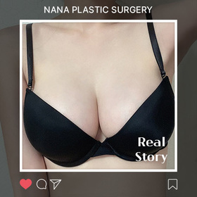 가슴성형, 멘토 스무스 후기