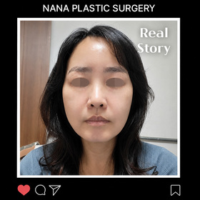 안면거상 후기