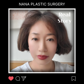 안면거상 후기