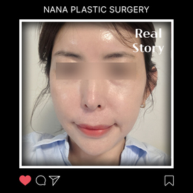 안면윤곽 후기