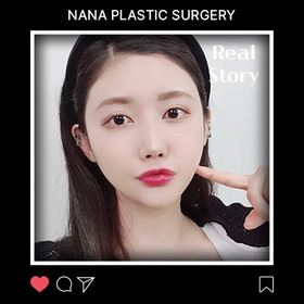 사각턱, 앞턱, 절개재수술, 코, 지방이식 후기